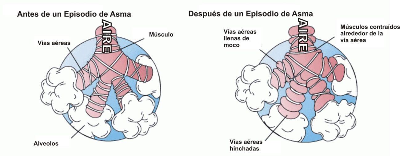 Expertos sugieren: Técnicas de meditación y relajación para pacientes con asma.
