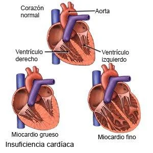 II. Factores a Considerar en el⁣ Manejo de la Insuficiencia Cardíaca ⁣en Hogares Geriátricos de Medellín