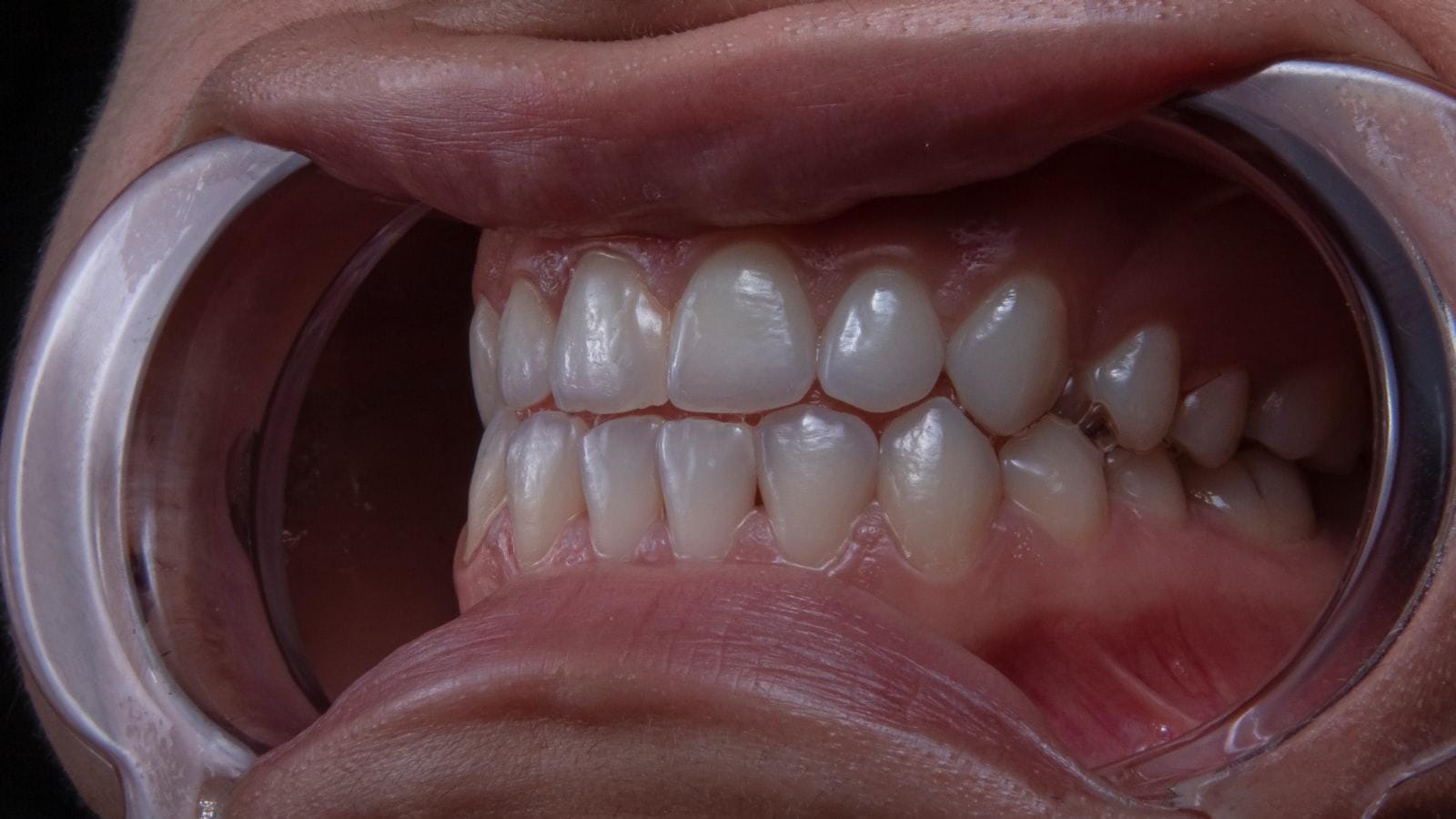 Recomendaciones específicas de medicamentos orales para el manejo de la diabetes tipo 2 en adultos mayores