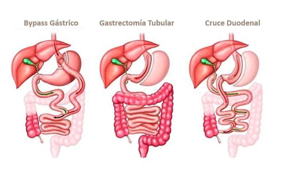 Beneficios de la cirugía bariátrica en adultos mayores: ¿qué resultados se pueden esperar?