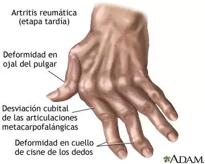 Factores que influyen en los síntomas de la artritis reumatoide en diferentes climas