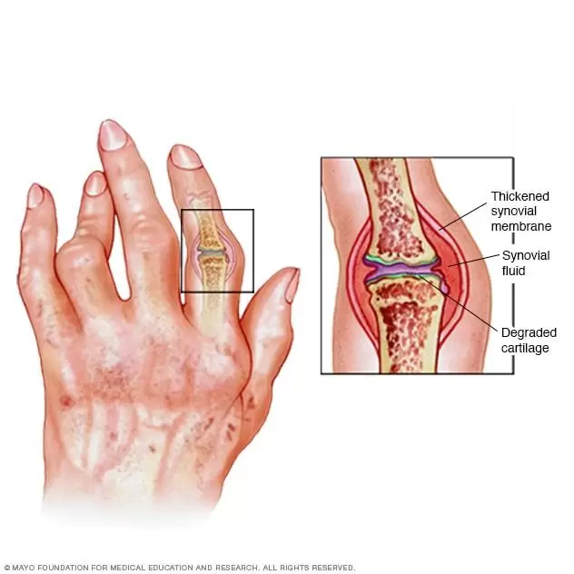 Impacto de la artritis reumatoide en el sistema gastrointestinal