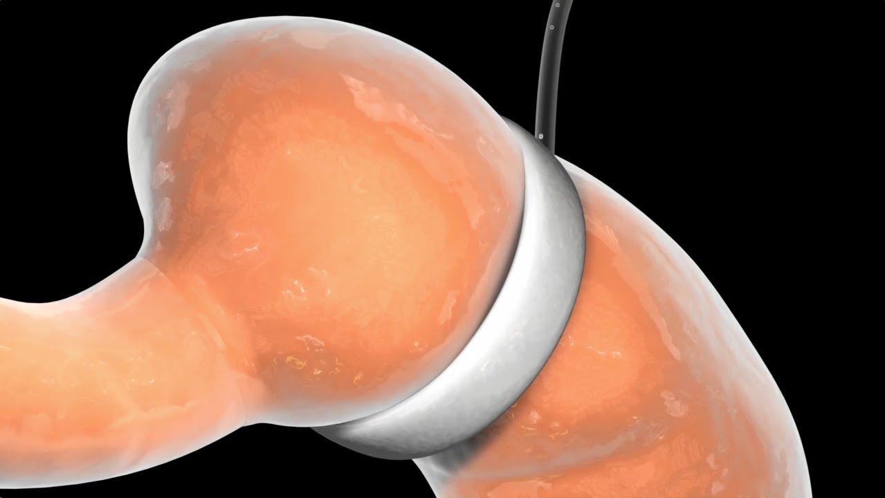 Consideraciones especiales ​para la cirugía bariátrica ⁣en ⁣adultos mayores
