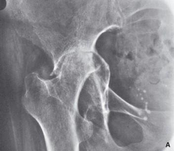 Análisis⁣ de los resultados y ‌pronósticos⁢ de ⁣intervenciones quirúrgicas en⁣ Medellín para la ⁢artritis reumatoide en adultos mayores