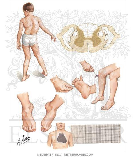 Avances en la investigación de nuevas terapias farmacológicas para​ la Ataxia⁣ de Friedreich en Medellín