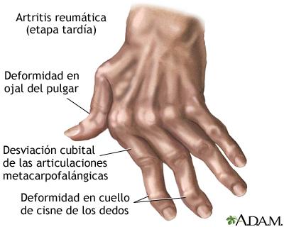 Impacto de la artritis reumatoide en la vida cotidiana de los ancianos en Medellín