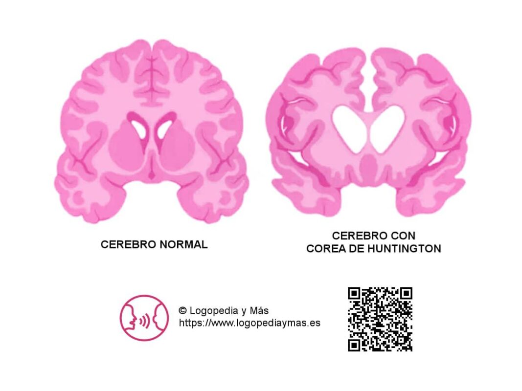 Estudios recientes demuestran que la nutrición influye en la Corea de Huntington en hogares geriátricos de Medellín