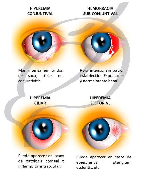 Cómo manejar la inflamación ocular⁣ asociada ⁢a la artritis reumatoide <a href=