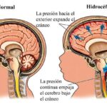 Qué dice la investigación sobre la relación entre la Hidrocefalia de Presión Normal y la nutrición en geriátricos de Medellín