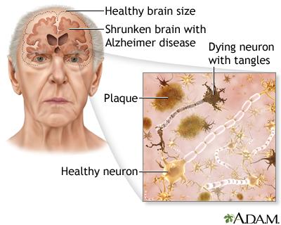 5 señales de que el Alzheimer está avanzando y cómo afrontarlo en Medellín