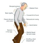 Qué dice la investigación sobre la relación entre el Parkinson y la nutrición en geriátricos de Medellín