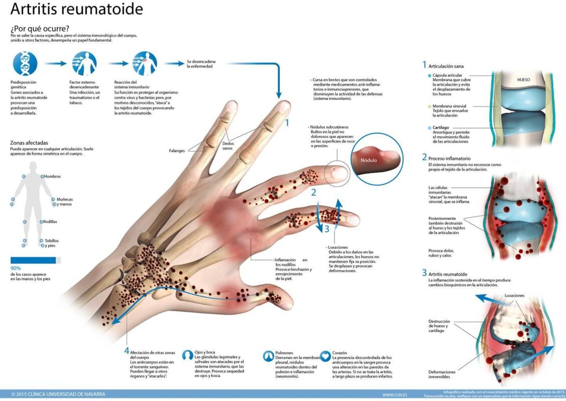 Comparativa de efectos secundarios de terapias biológicas en el tratamiento de la artritis reumatoide. en Medellín en Medellín