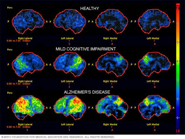 Errores comunes al diagnosticar el Alzheimer y cómo evitarlos en Medellín