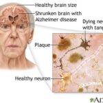 Los estudios muestran que la interacción social es fundamental para personas con Alzheimer en geriátricos de Medellín
