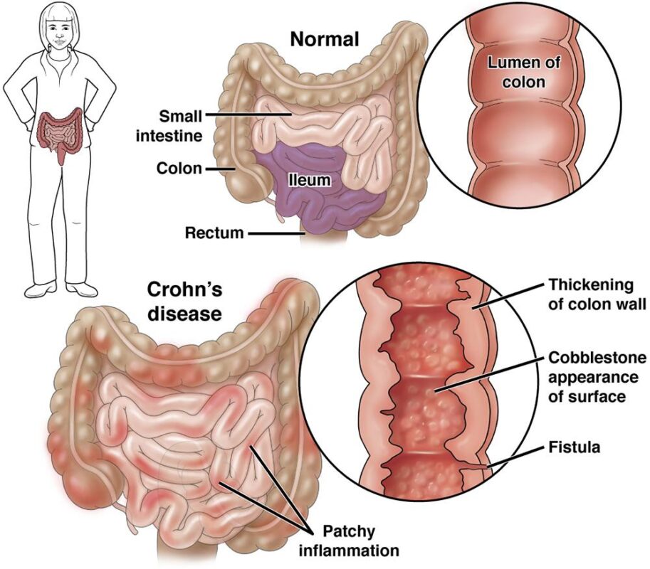 Datos sobre el impacto del estrés en la actividad de la enfermedad de Crohn. en Medellín en Medellín