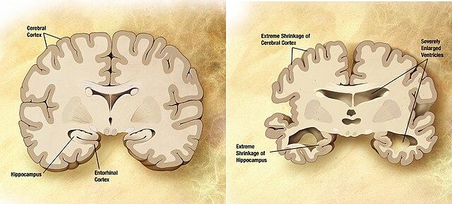 Beneficios psicológicos y emocionales de la interacción social en personas con Alzheimer