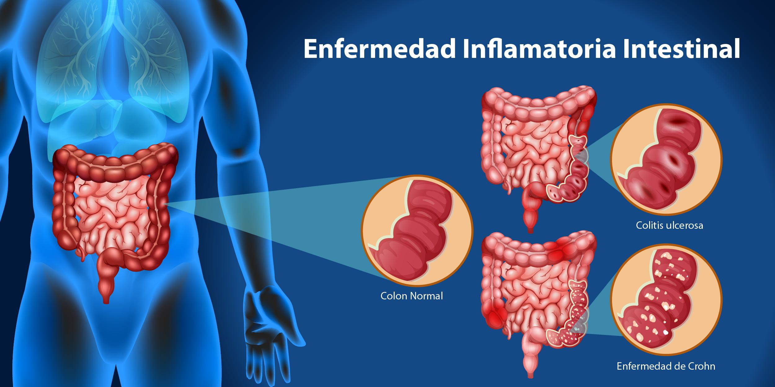 Impacto de la enfermedad de Crohn en la calidad de vida de los adultos mayores en Medellín