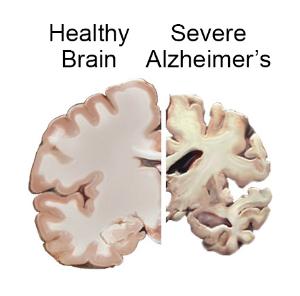 Importancia de la interacción social en el bienestar de personas con Alzheimer