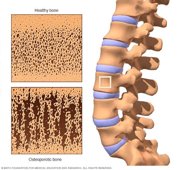 Aspectos ​a considerar en el⁢ manejo de la ⁢osteoporosis en pacientes con artritis‌ reumatoide