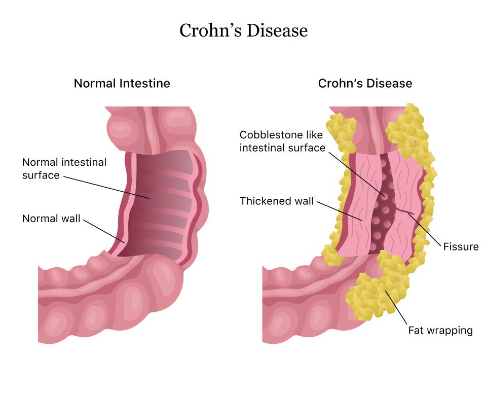 Reseña de programas de ejercicio físico para la mejora de la calidad de vida en la enfermedad de Crohn. en Medellín en Medellín