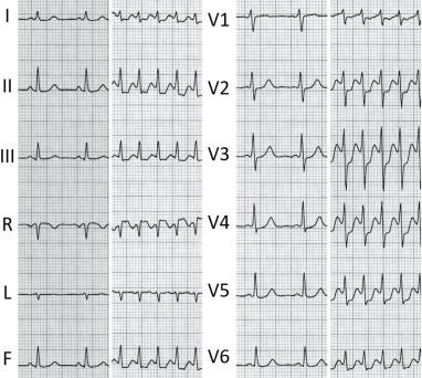 Consideraciones clave en el manejo de arritmias avanzadas