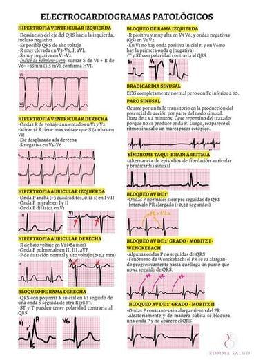 Tipos de Arritmias y Sus Síntomas Asociados