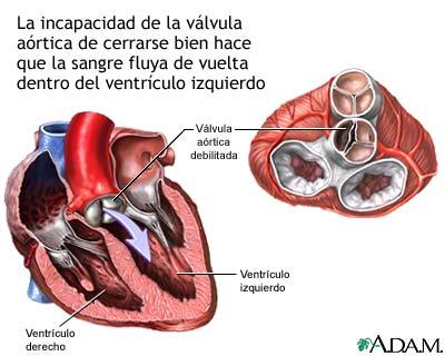 Efectos de la insuficiencia valvular cardíaca en la calidad de vida de los adultos mayores
