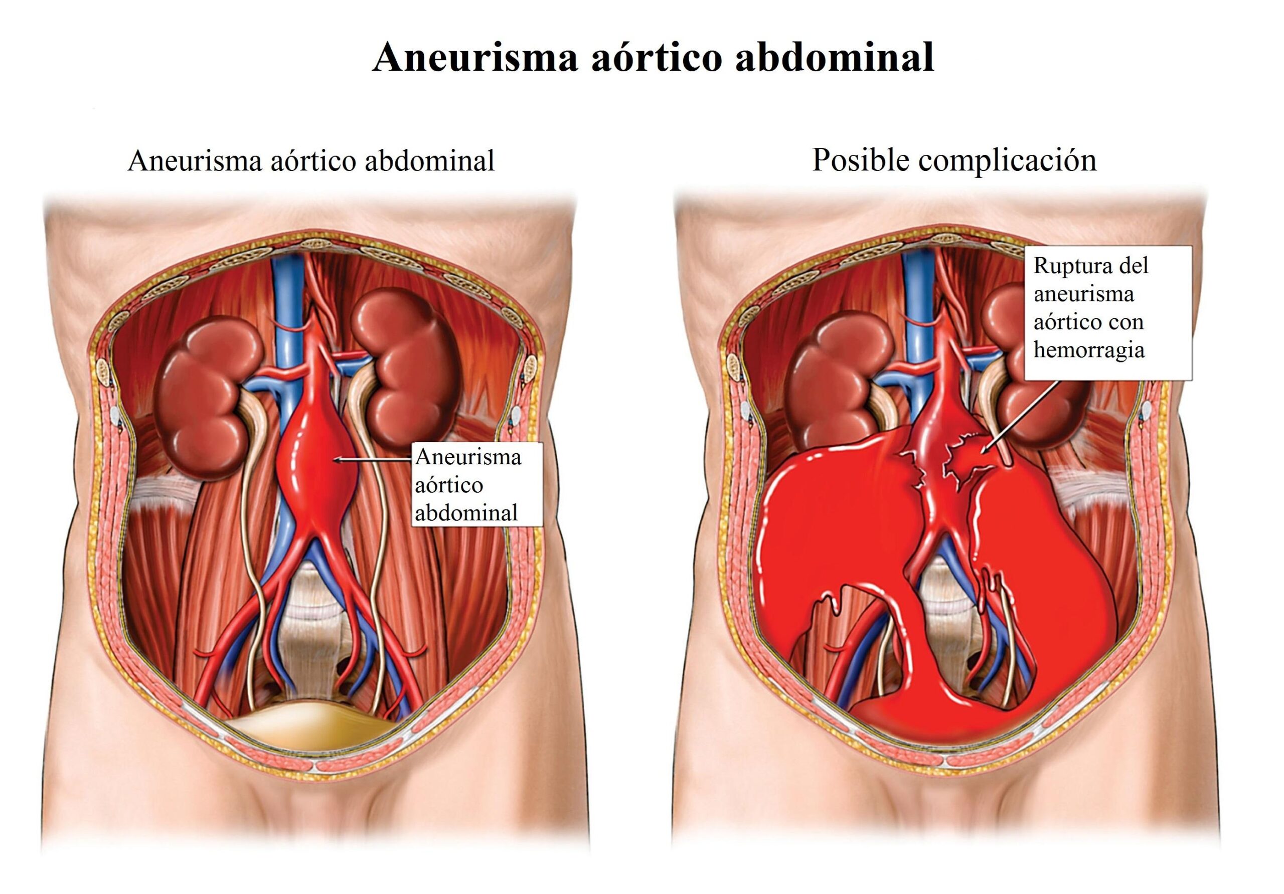 Manejo de aneurismas aórticos asintomáticos en hogares geriátricos.