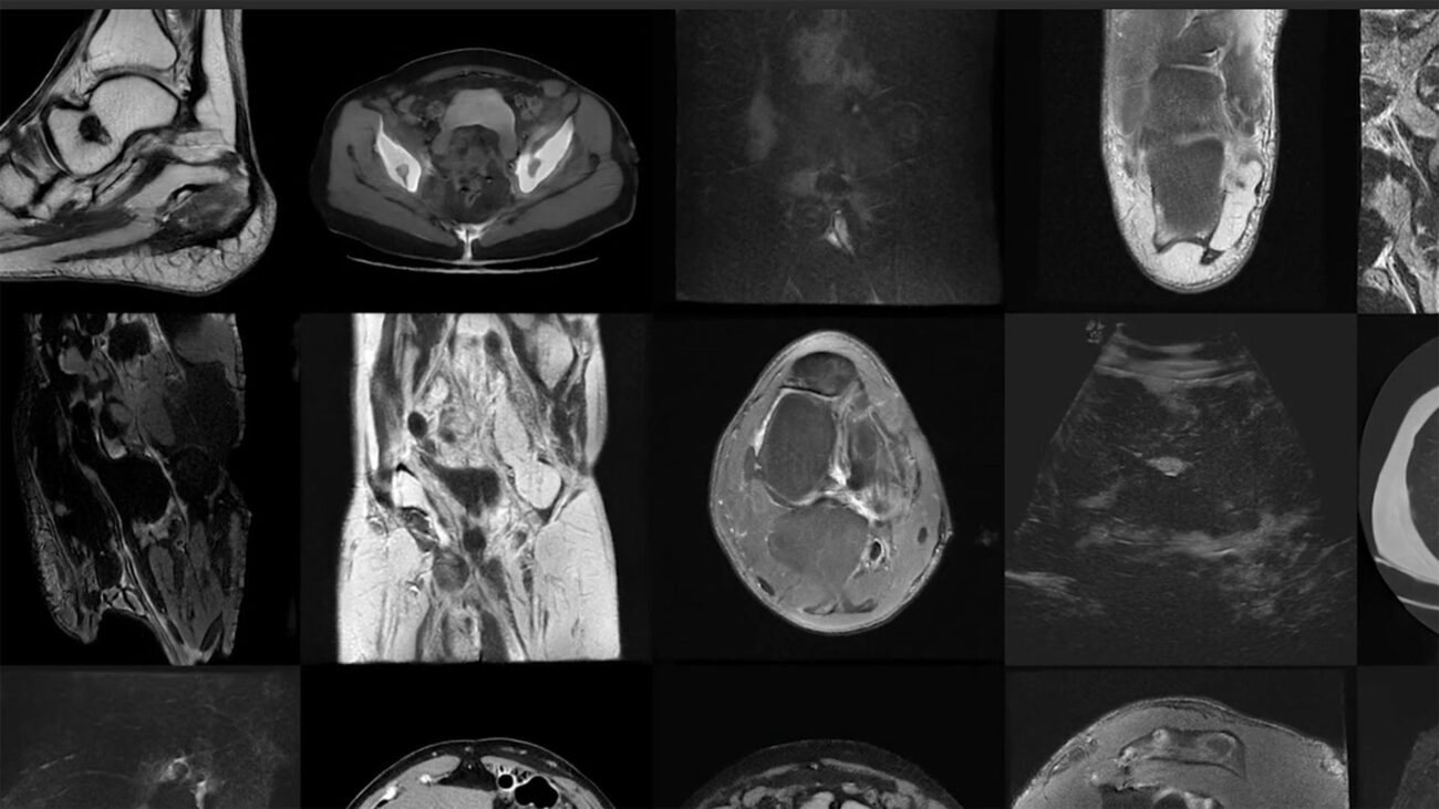 Uso de imágenes médicas para el seguimiento de aneurismas aórticos en geriátricos.