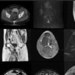 Uso de imágenes médicas para el seguimiento de aneurismas aórticos en geriátricos.
