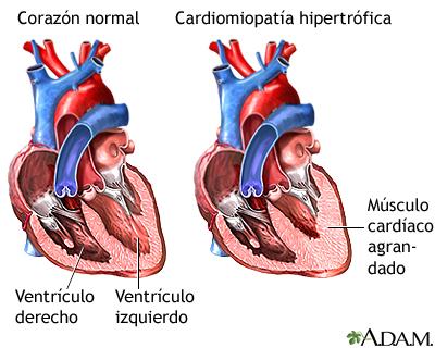 Miocardiopatía dilatada