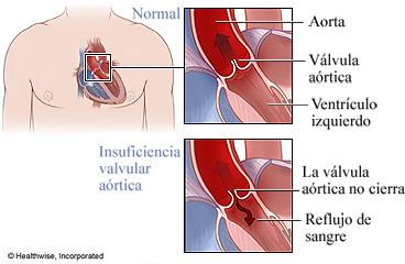 Consideraciones especiales en el tratamiento de la insuficiencia valvular en adultos mayores