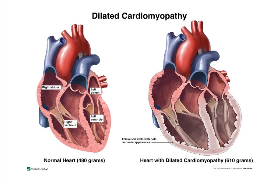 Recomendaciones específicas para el seguimiento de la miocardiopatía dilatada en pacientes geriátricos