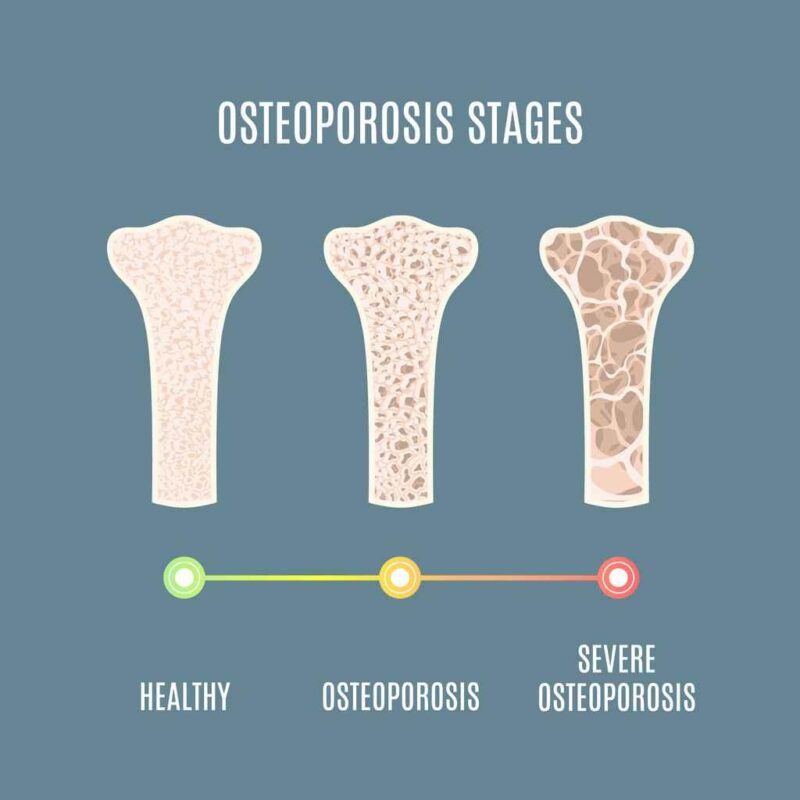 «Osteoporosis: entorno adaptado para prevenir fracturas en Sonríe a la Vida»
